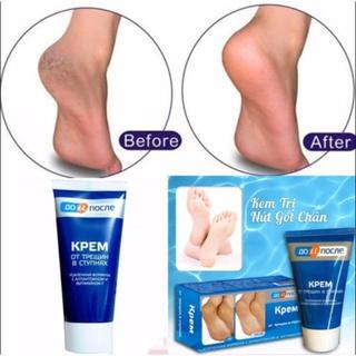 Kem nẻ gót chân Kpem Foot Cream giảm nẻ chân nứt chân khô da chân dưỡng gót chân