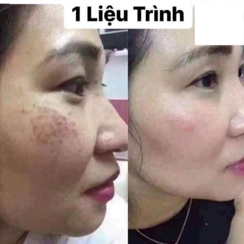 Tác dụng phụ của viên uống trắng da là gì?